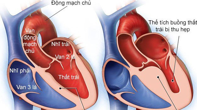 Phình thất trái làm kích thước buồng tim tâm thất trái bị thu hẹp.webp